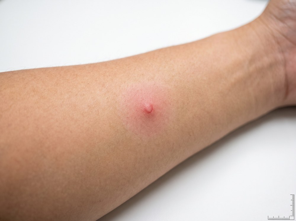 Close-up photo of a faint pink scratch line and small red dot on skin from a June beetle's spiny leg, with no swelling or puncture visible